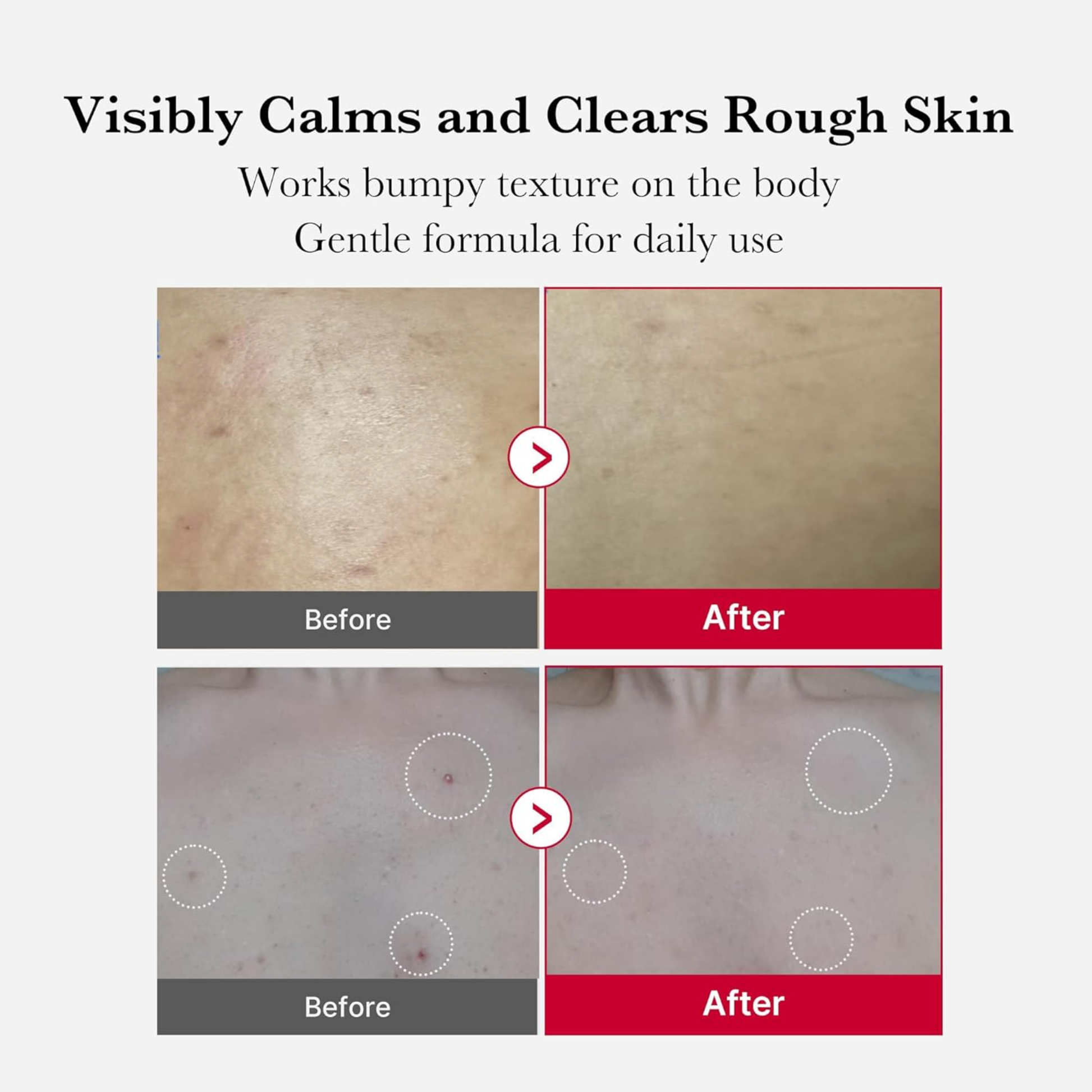 Red Acne Body Peeling Shot - Body Care