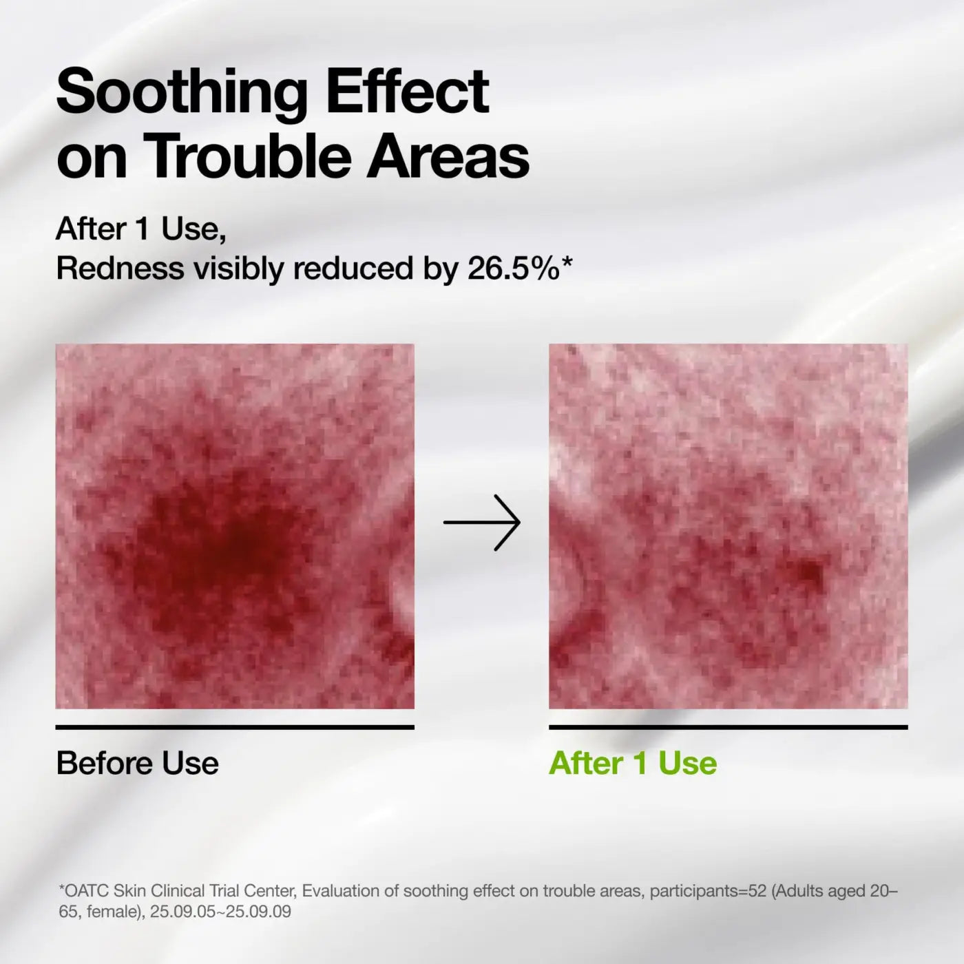 Azelaic acid cica skin soothing moisturizer visibly reduces redness in trouble areas after one use with before and after