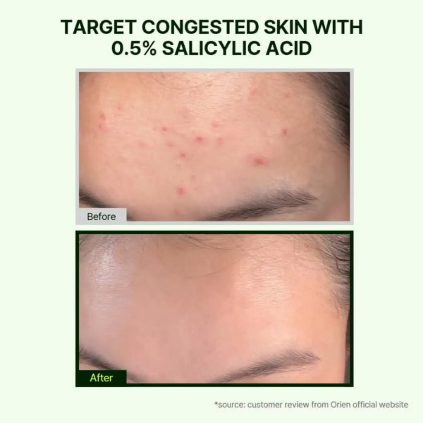 Mugwort zero film cleansing foam 150ml with 0.5% salicylic acid targets congested skin to clear acne and improve complexion